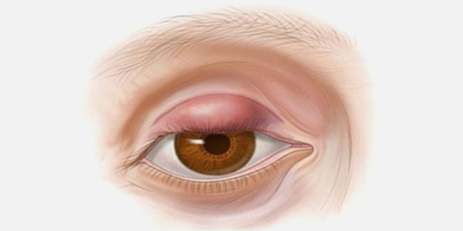 Dieta e Patologie: IL CALAZIO