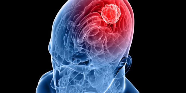 Ictus giovanile, attenzione agli stili di vita