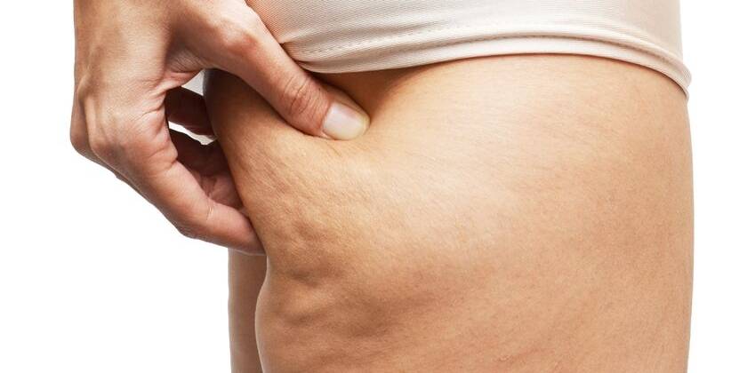 Panniculopatia PEFS: il giusto nome della cellulite